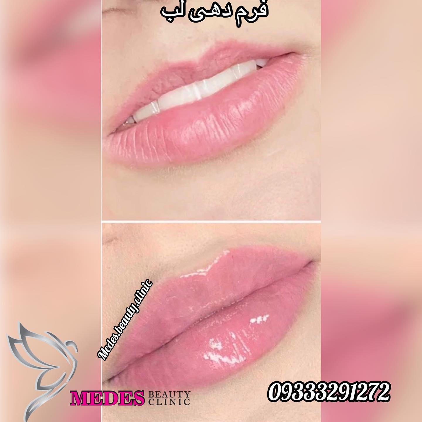 گالری تزریق ژل لب